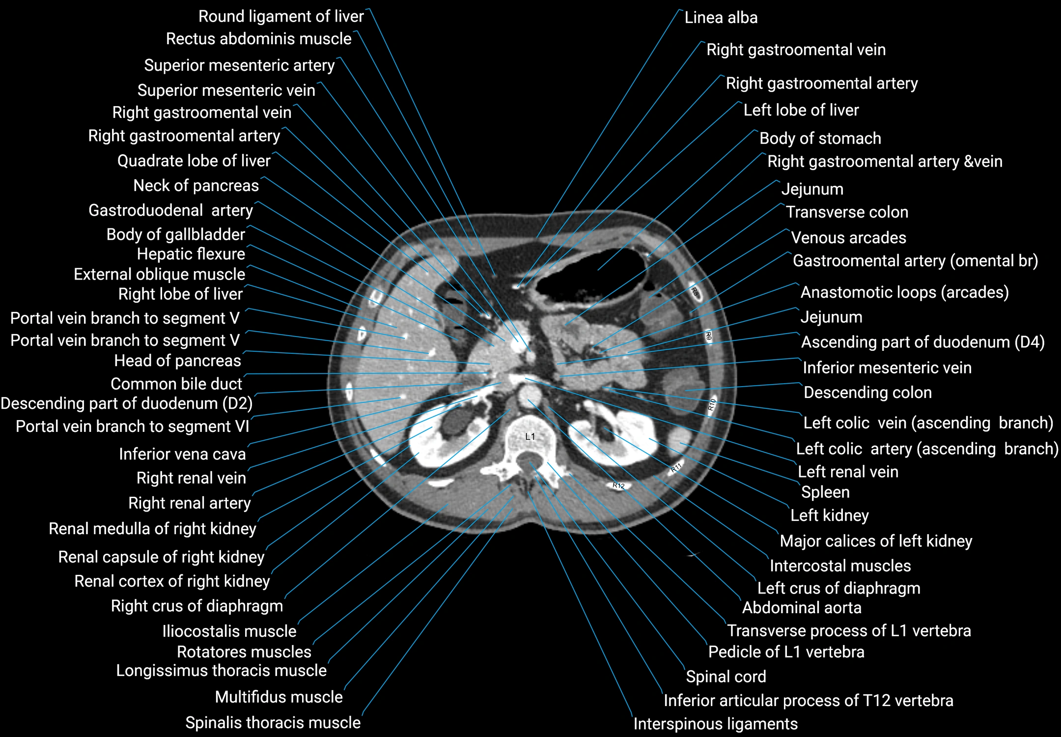 CT male pelvis axial cross sectional anatomy labelled radiology image -00056.webp